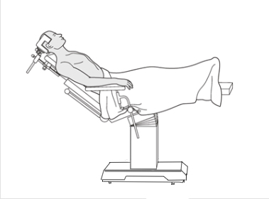 Beach Chair Surgical Position: Benefits, Risks, and Best Practices
