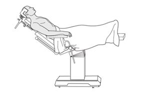 Understanding the Beach Chair Surgical Position